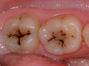 Fluorose Karries 300x225 Fluoride